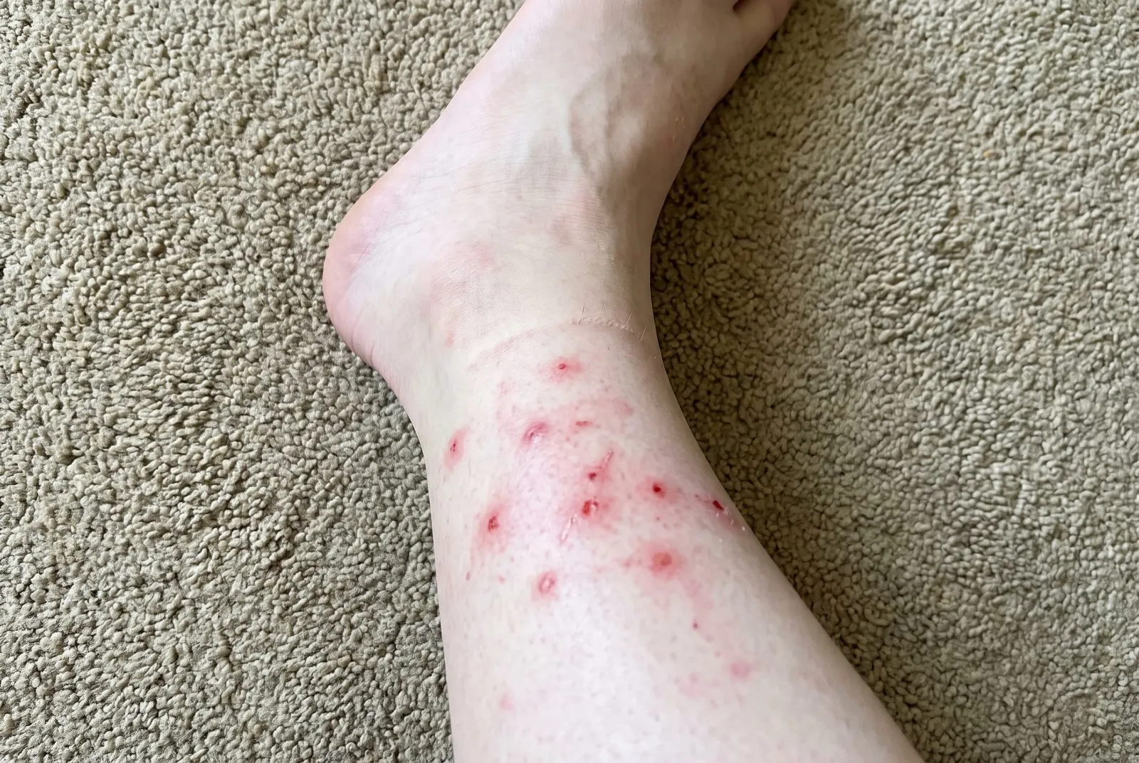 Bites around ankles